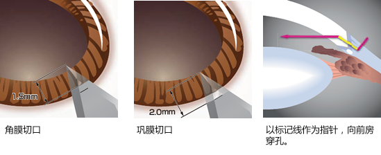 Example of use of the marking lines (main incision)