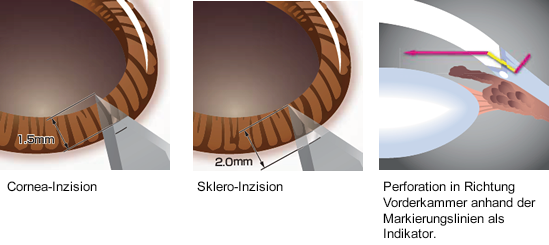 Example of use of the marking lines (main incision)