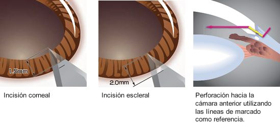 Example of use of the marking lines (main incision)