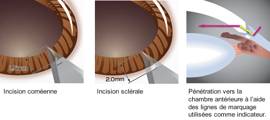 Example of use of the marking lines (main incision)