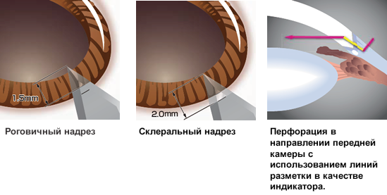 Example of use of the marking lines (main incision)