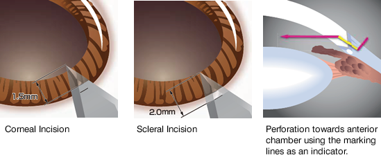 Example of use of the marking lines (main incision)